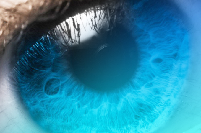 cirugía refractiva