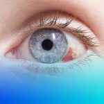 derrame ocular