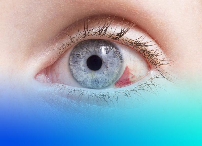 derrame ocular