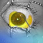crosslinking corneal con el dr. jorge montaño