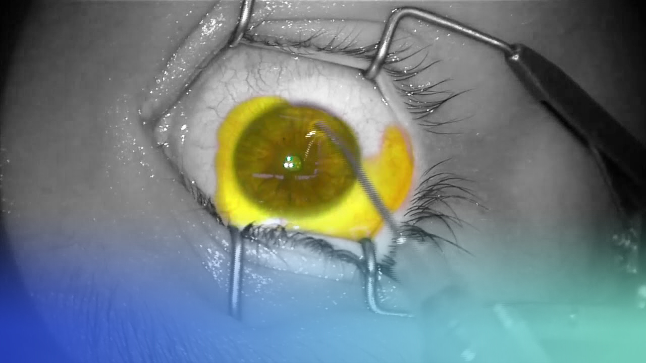 crosslinking corneal con el dr. jorge montaño