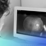 desprendimiento de retina