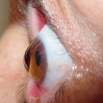 queratocono oftalmologia