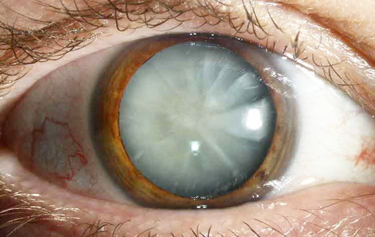 oftalmologia catarata